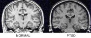 PTSD brain courtesy of NeuroAnthropology